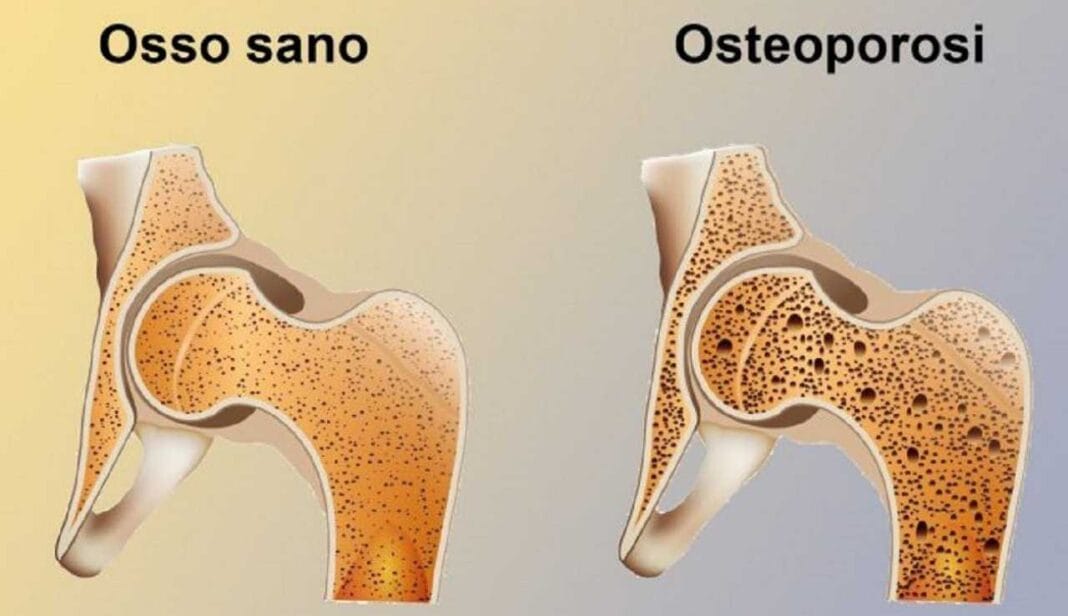 l-osteoporosi-fhcr